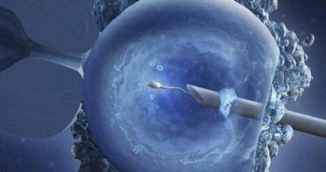 лечение имунного бесплодия